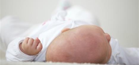 When a Baby’s Head is Misshapen: Positional Skull Deformities